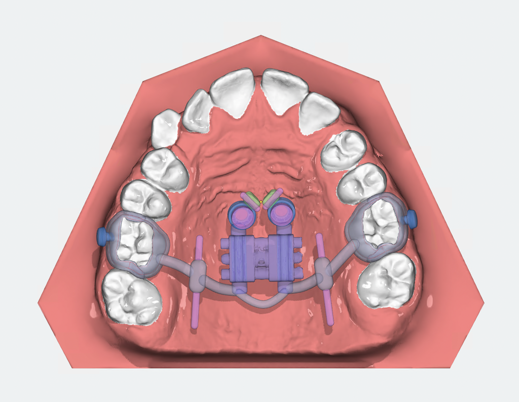 Projekt aparatu hybridHyrax z Dystlslider z guzikami do Mentoplate zaprojektowany w OnyxCeph