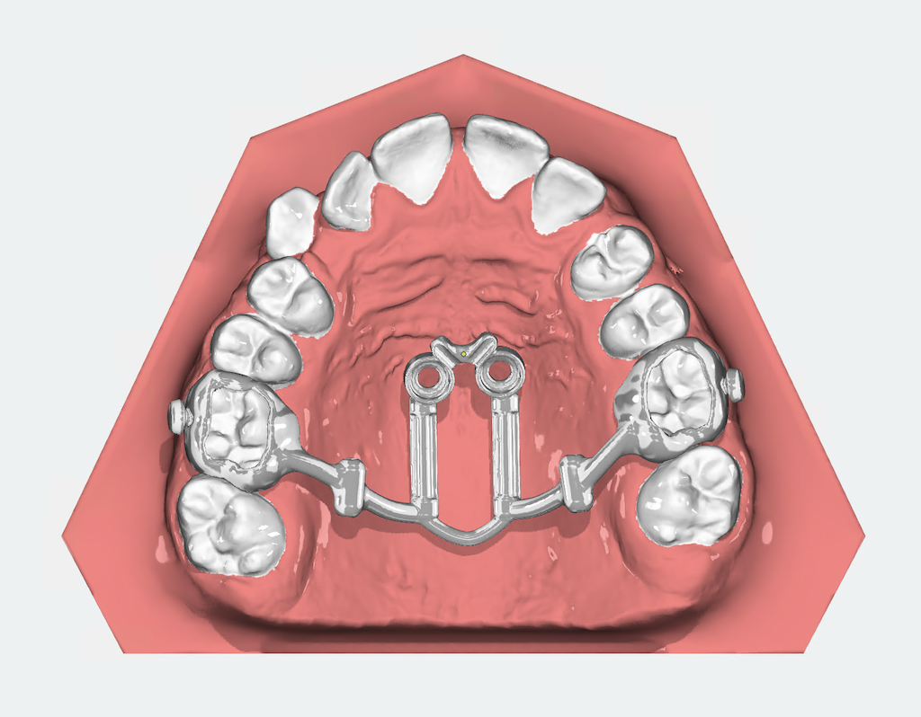 Projekt aparatu hybridHyrax z Dystlslider z guzikami do Mentoplate zaprojektowany w OnyxCeph