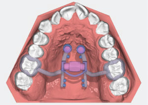 Szkolenie OnyxCeph - HybridHyrax z PowerScrew z intrusion hooks