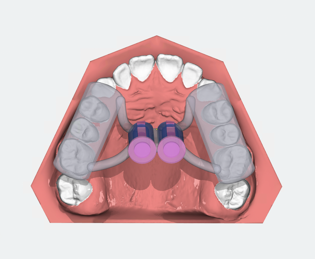 Projekt szablonu do wprowadzania mikroimplantów zaprojektowany w OnyxCeph