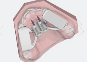 Project szablonu do mikroimplantów w OnyxCeph