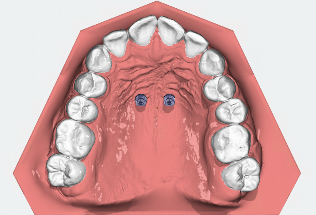 OnyxCeph - Szablony do mikroimplantów - pozycjonowanie mikroimplantów