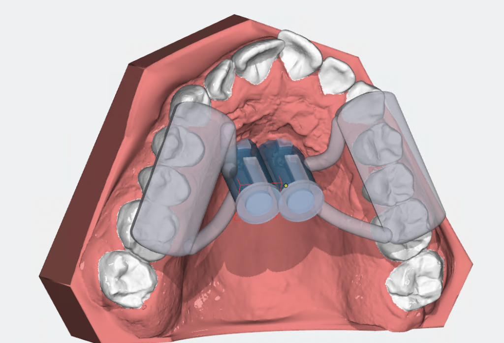 OnyxCeph - Szablony do mikroimplantów - projekt aparatu