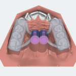 Szkolenie OnyxCeph - Szablon do mikroimplantów